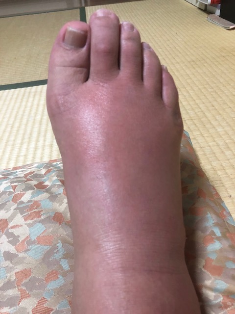 翌日 た 蜂 刺され 腫れる に